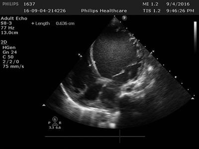 Case report: Myocardial noncompaction causing massive cerebral infarction in 1 patient with eyelid edema as an early manifestation and literature review